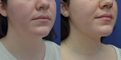 Liposuction Before & After Gallery - Patient 80448945 - Image 4