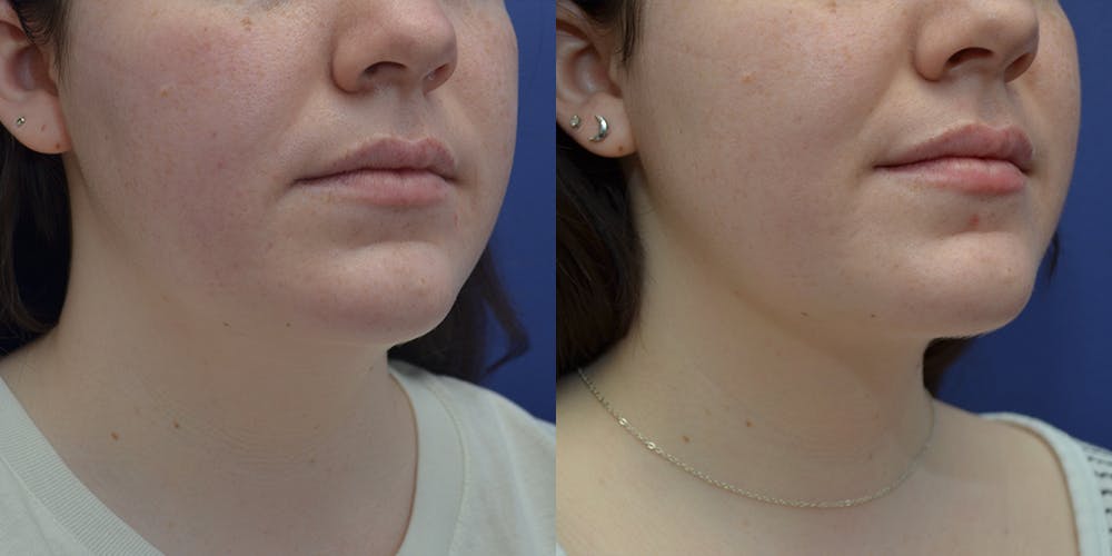 Liposuction Before & After Gallery - Patient 80448945 - Image 4