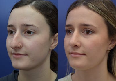 Rhinoplasty (Nose Reshaping) Gallery - Patient 30353998 - Image 2