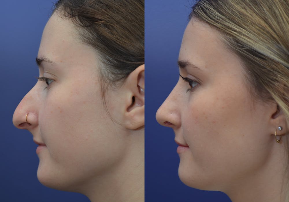 Rhinoplasty (Nose Reshaping) Gallery - Patient 30353998 - Image 3