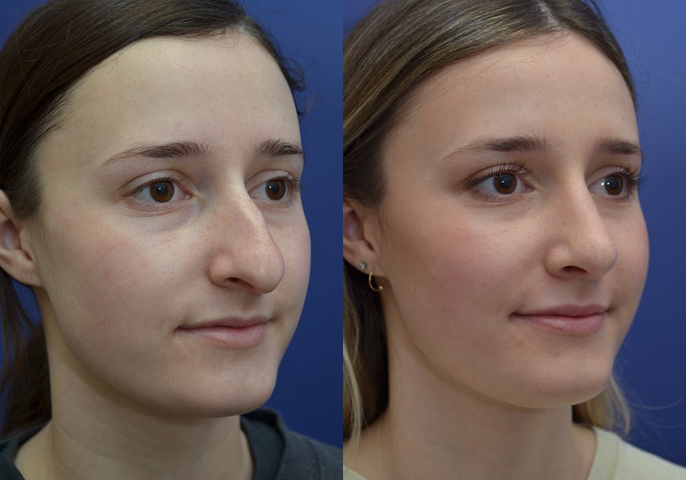 Rhinoplasty (Nose Reshaping) Gallery - Patient 30353998 - Image 4