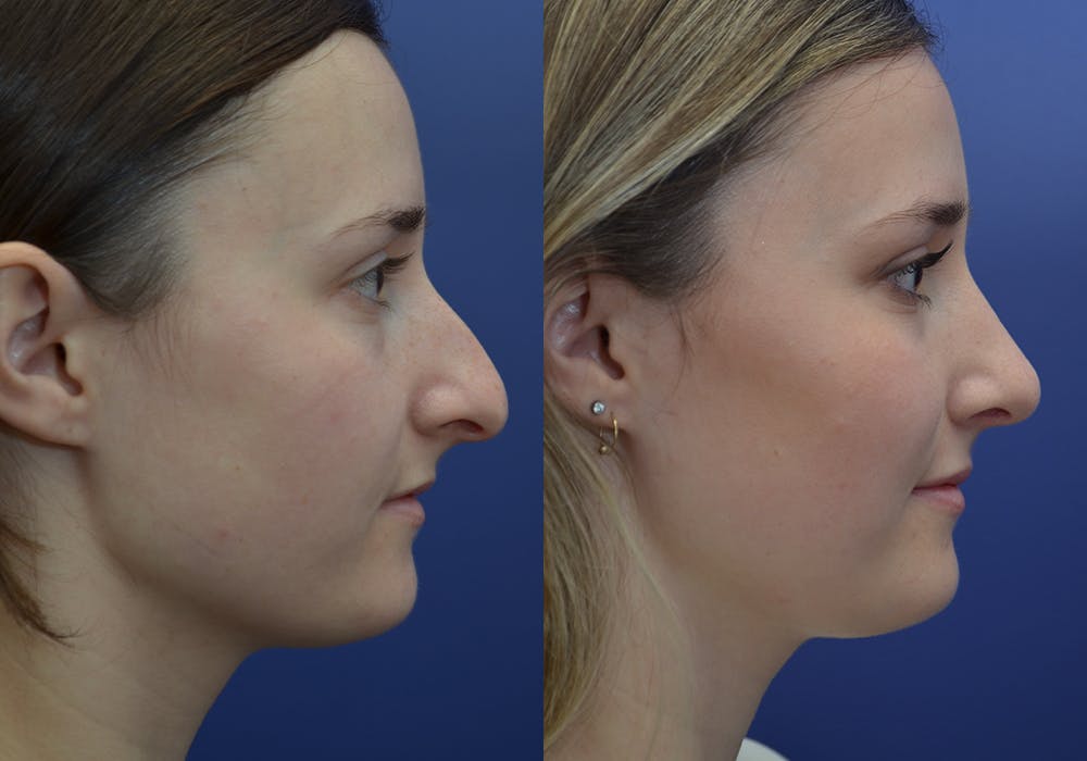 Rhinoplasty (Nose Reshaping) Gallery - Patient 30353998 - Image 5