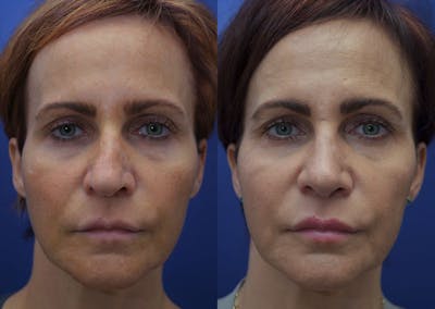 Rhinoplasty (Nose Reshaping) Before & After Gallery - Patient 40632366 - Image 1