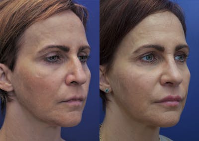 Rhinoplasty (Nose Reshaping) Before & After Gallery - Patient 40632366 - Image 2