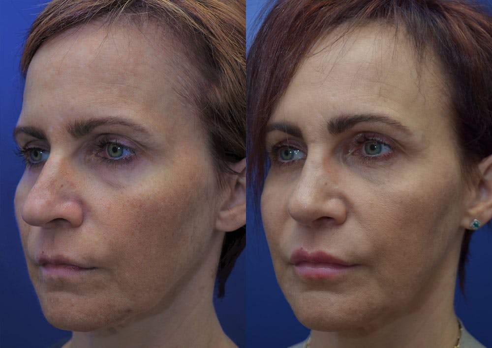 Rhinoplasty (Nose Reshaping) Gallery - Patient 40632366 - Image 3