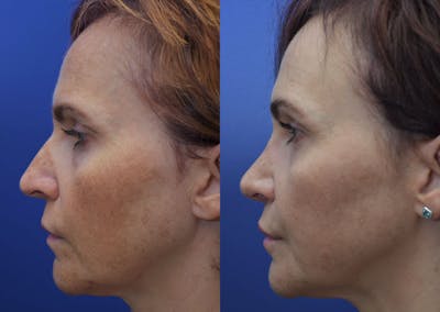 Rhinoplasty (Nose Reshaping) Before & After Gallery - Patient 40632366 - Image 4