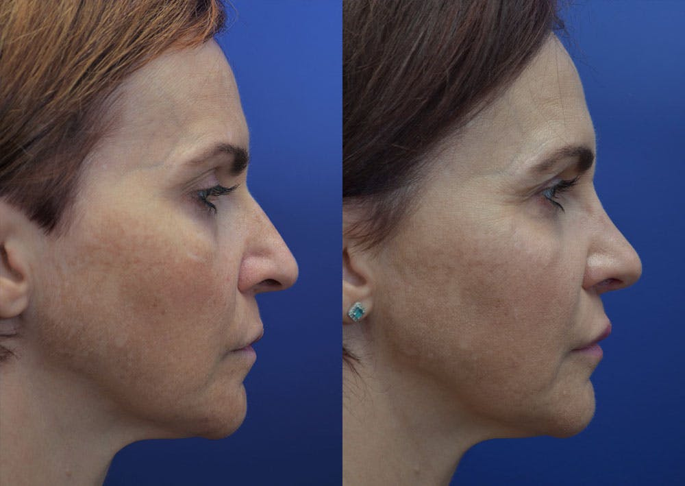 Rhinoplasty (Nose Reshaping) Before & After Gallery - Patient 40632366 - Image 5