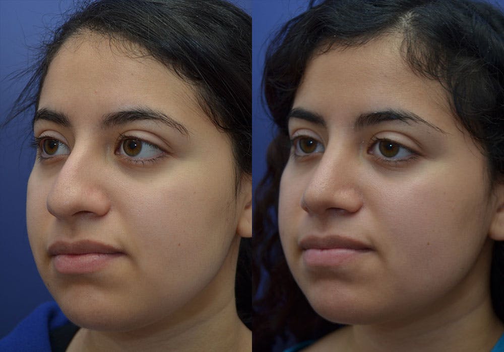 Rhinoplasty (Nose Reshaping) Gallery - Patient 87141652 - Image 1