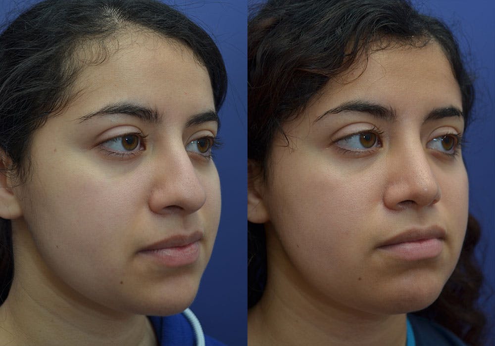 Rhinoplasty (Nose Reshaping) Gallery - Patient 87141652 - Image 2