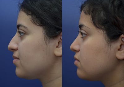 Rhinoplasty (Nose Reshaping) Gallery - Patient 87141652 - Image 4