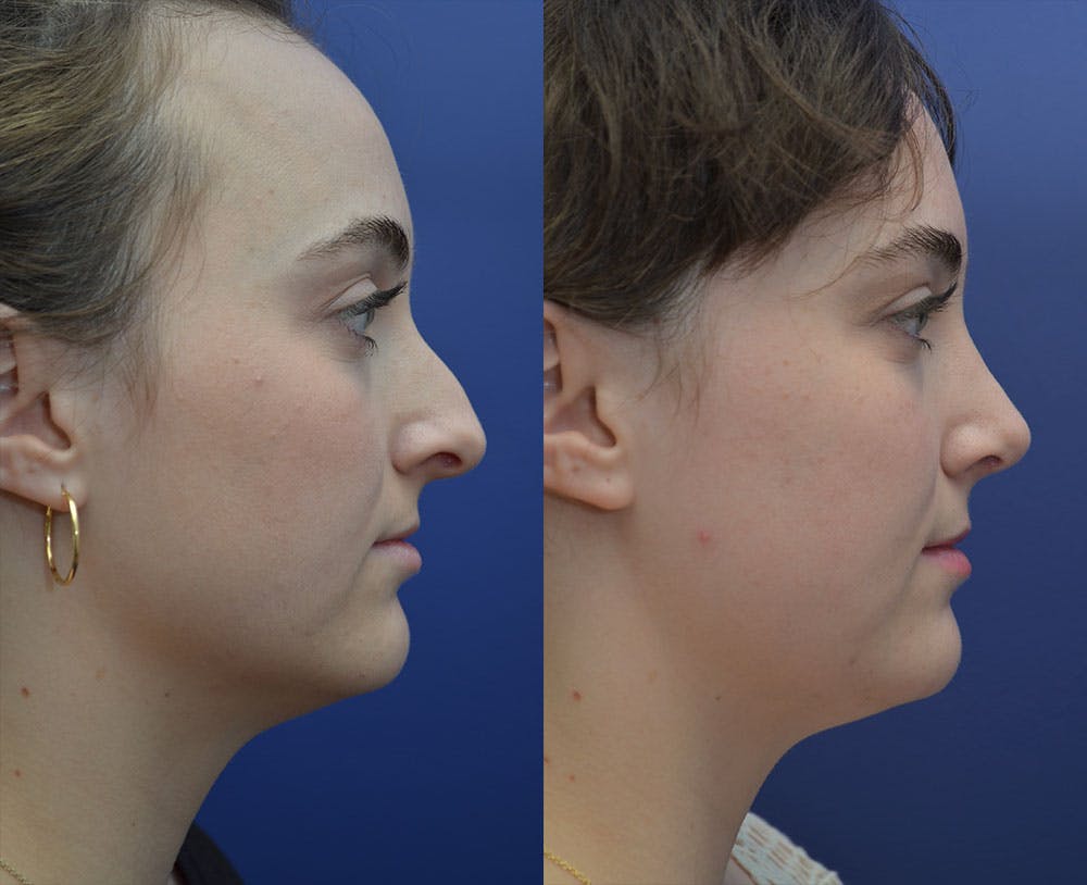 Rhinoplasty (Nose Reshaping) Gallery - Patient 53271088 - Image 1
