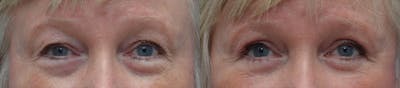 Eyelid Surgery Gallery - Patient 87141694 - Image 1