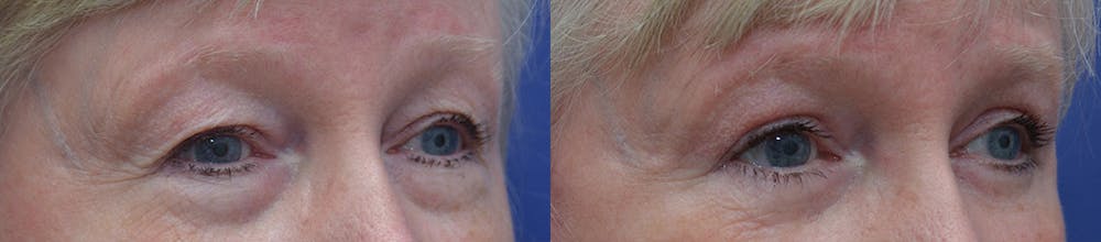 Eyelid Surgery Gallery - Patient 87141694 - Image 2