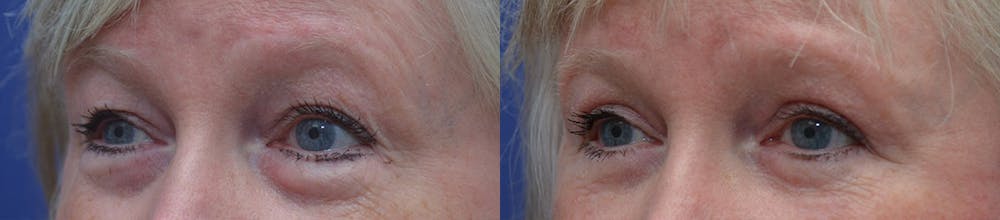 Eyelid Surgery Gallery - Patient 87141694 - Image 3