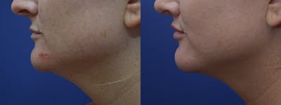 Lip Lift Before & After Gallery - Patient 18727959 - Image 4