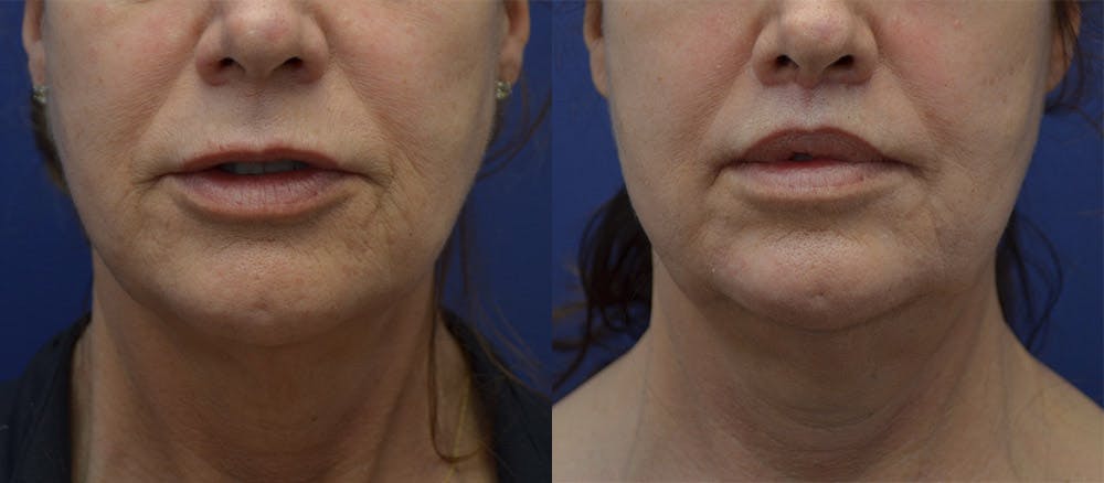 Lip Lift Before & After Gallery - Patient 104093705 - Image 1