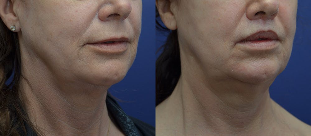 Lip Lift Before & After Gallery - Patient 104093705 - Image 2