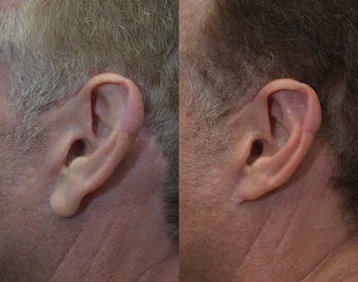 Ear Reshaping (Otoplasty) Before & After Gallery - Patient 80448833 - Image 2