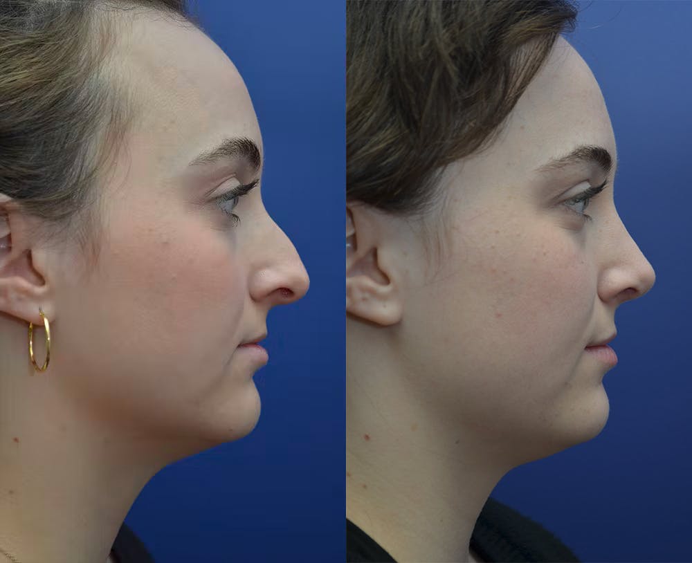 Rhinoplasty (Nose Reshaping) Before & After Gallery - Patient 53271088 - Image 2
