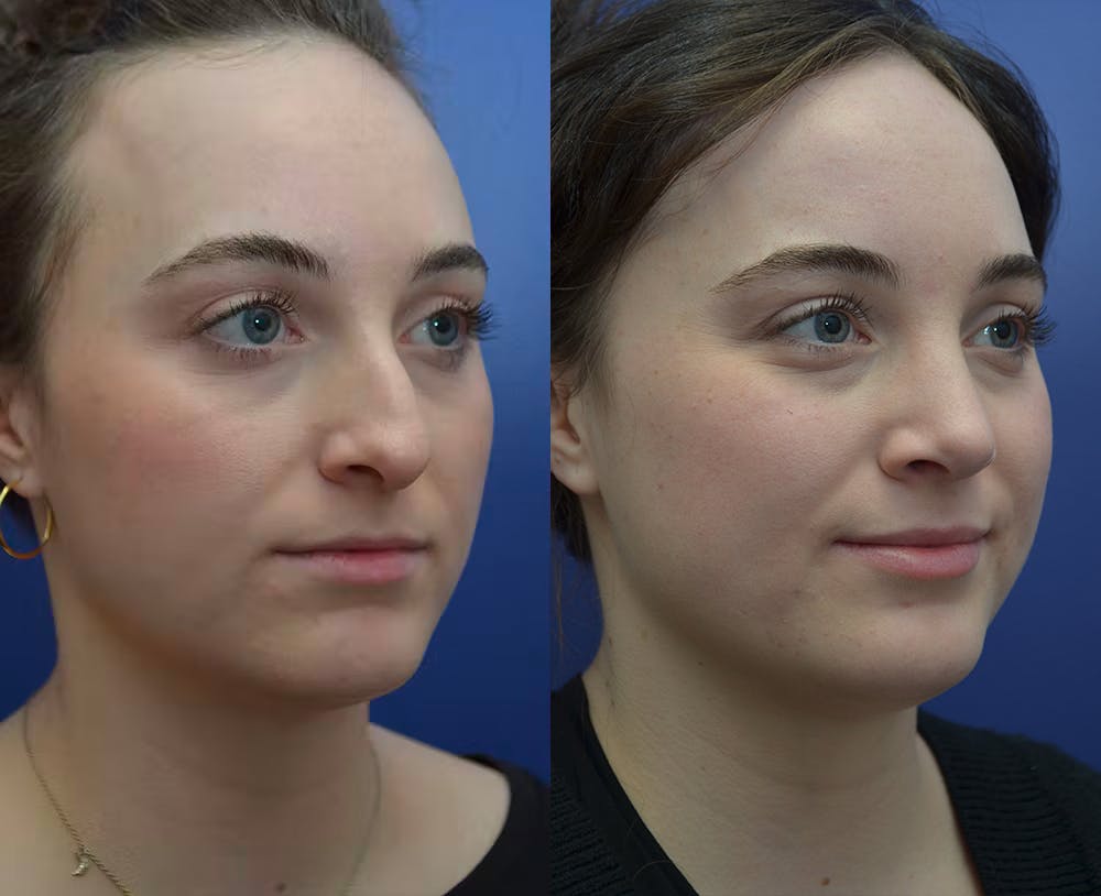 Rhinoplasty (Nose Reshaping) Before & After Gallery - Patient 53271088 - Image 3