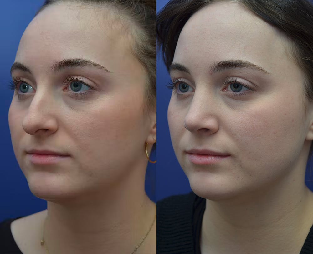 Rhinoplasty (Nose Reshaping) Before & After Gallery - Patient 53271088 - Image 4