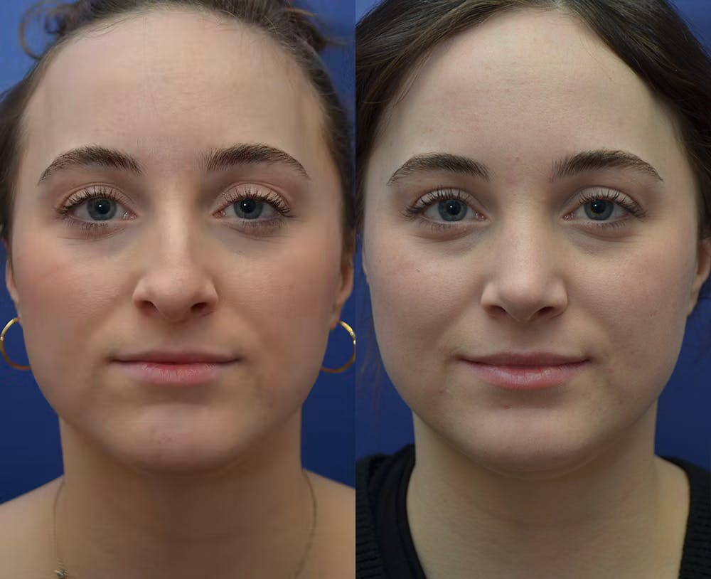 Rhinoplasty (Nose Reshaping) Gallery - Patient 53271088 - Image 5