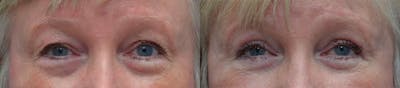 Eyelid Surgery Before & After Gallery - Patient 87141694 - Image 1