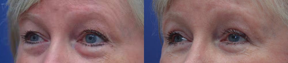 Eyelid Surgery Before & After Gallery - Patient 87141694 - Image 3