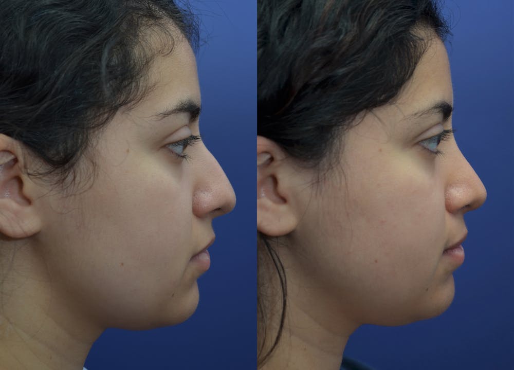 Rhinoplasty (Nose Reshaping) Before & After Gallery - Patient 87141652 - Image 3