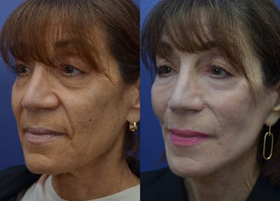 Rhinoplasty (Nose Reshaping) Gallery - Patient 113522167 - Image 1