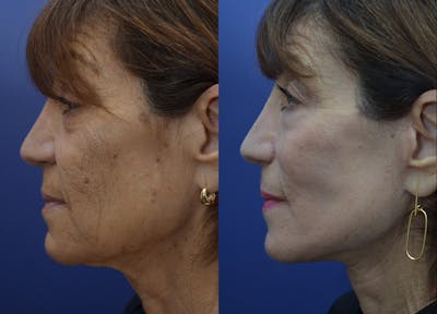 Rhinoplasty (Nose Reshaping) Gallery - Patient 113522167 - Image 2