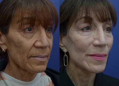 Rhinoplasty (Nose Reshaping) Gallery - Patient 113522167 - Image 4