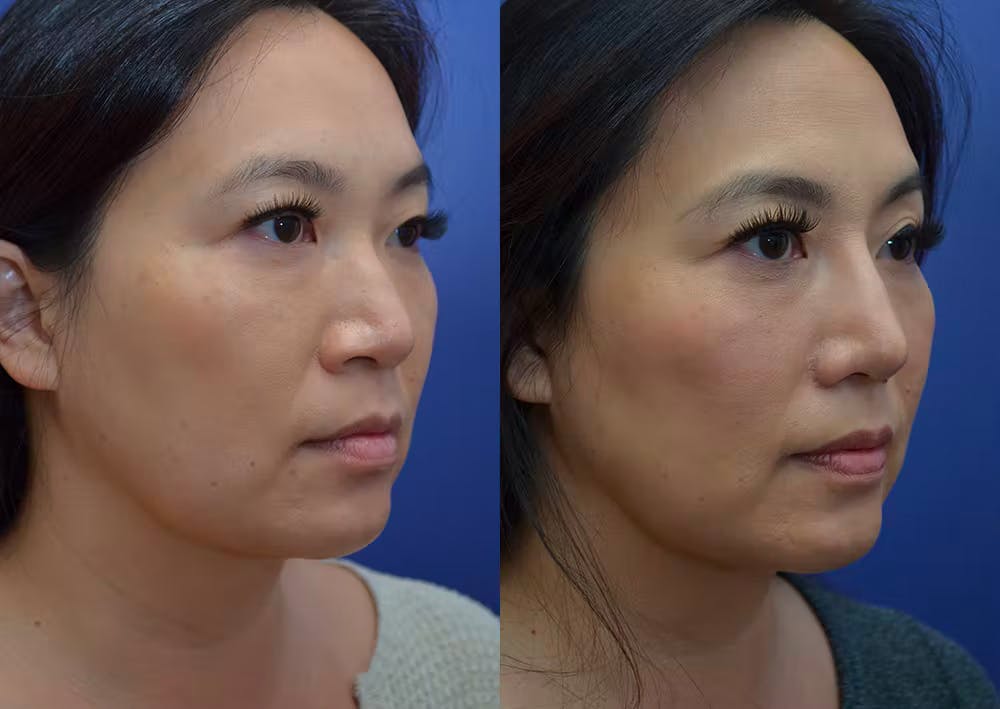 Rhinoplasty (Nose Reshaping) Before & After Gallery - Patient 20903687 - Image 3