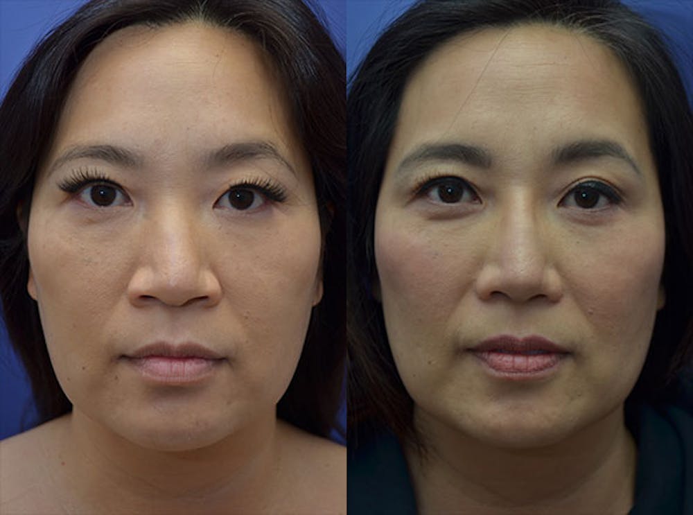 Alarplasty Before & After Gallery - Patient 123887608 - Image 1