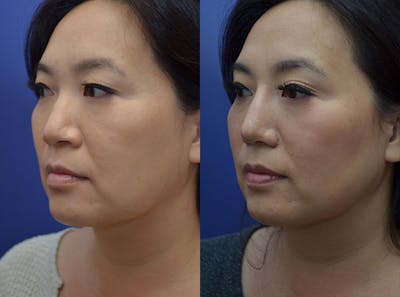 Alarplasty Before & After Gallery - Patient 123887608 - Image 2
