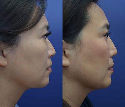 Rhinoplasty (Nose Reshaping) Gallery - Patient 20903687 - Image 4