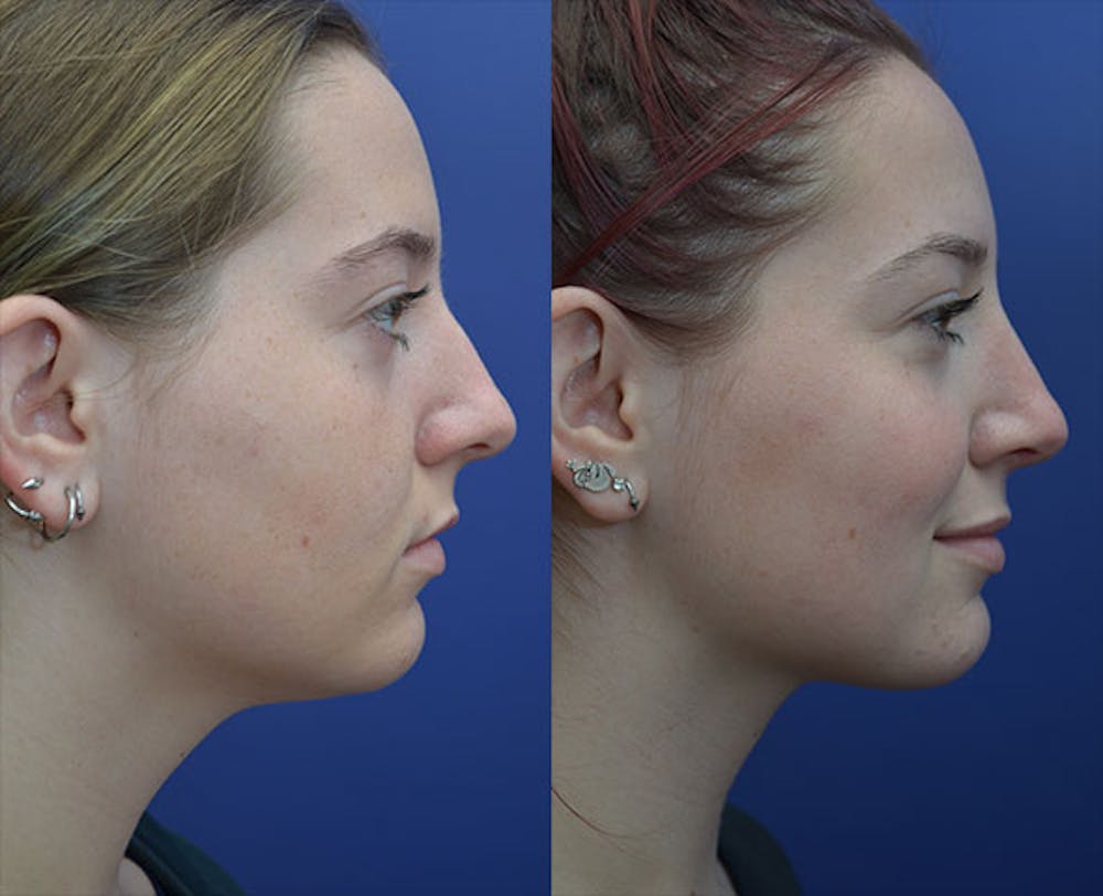 Liposuction Before & After Gallery - Patient 118980126 - Image 1