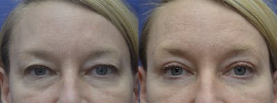 Eyelid Surgery Before & After Gallery - Patient 120723142 - Image 1