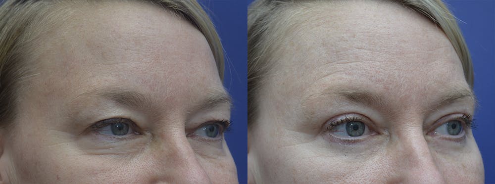 Eyelid Surgery Before & After Gallery - Patient 120723142 - Image 3