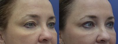 Eyelid Surgery Before & After Gallery - Patient 120723141 - Image 1