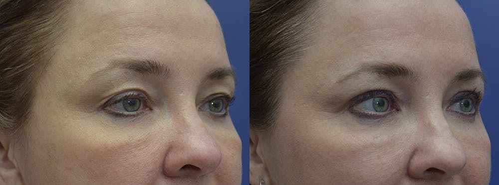 Eyelid Surgery Before & After Gallery - Patient 120723141 - Image 1