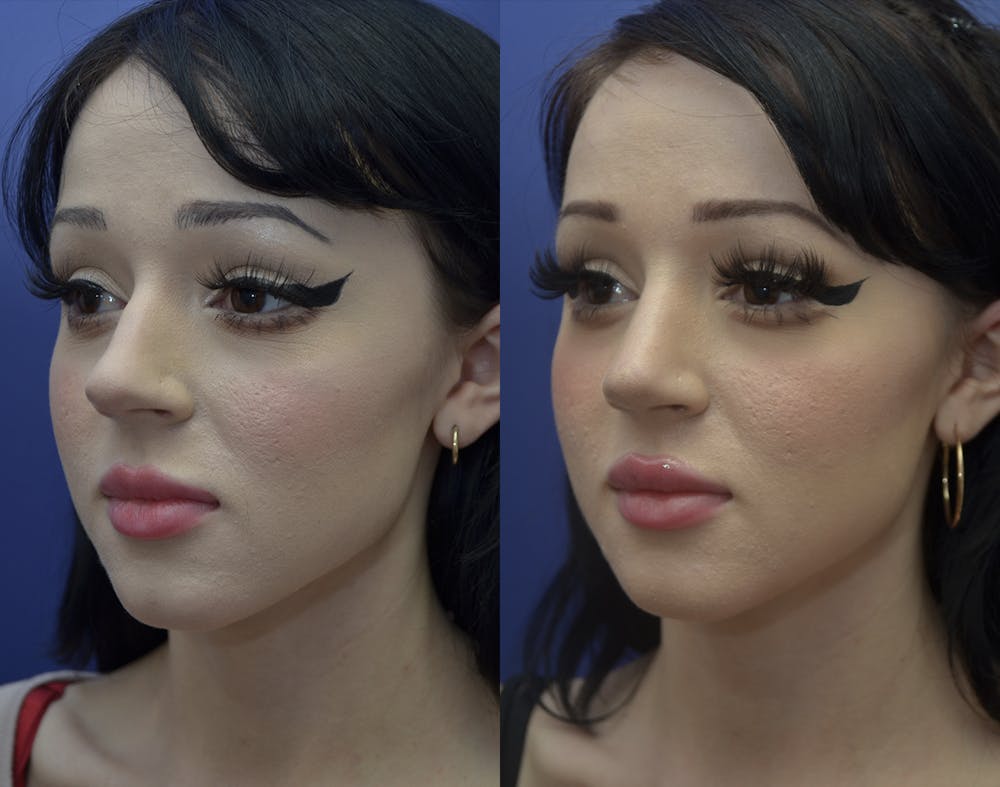 Rhinoplasty (Nose Reshaping) Before & After Gallery - Patient 121201309 - Image 1