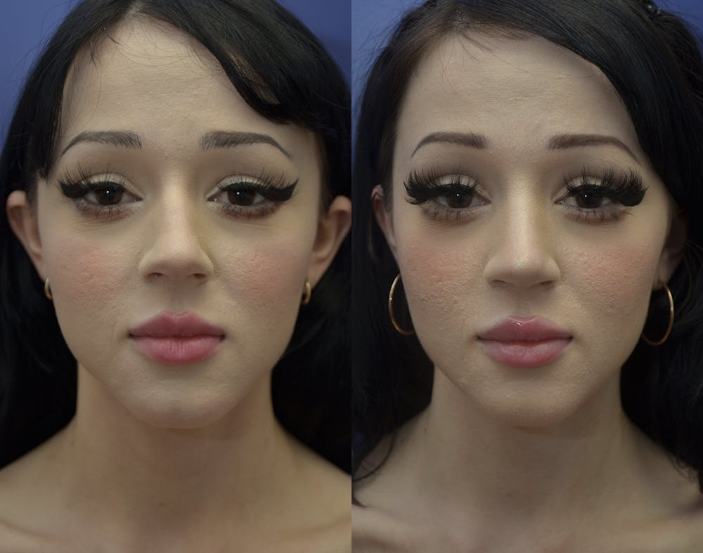 Rhinoplasty (Nose Reshaping) Before & After Gallery - Patient 121201309 - Image 2
