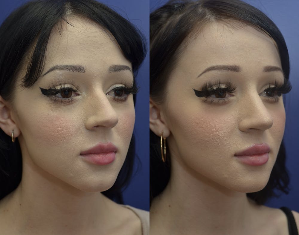 Rhinoplasty (Nose Reshaping) Before & After Gallery - Patient 121201309 - Image 4