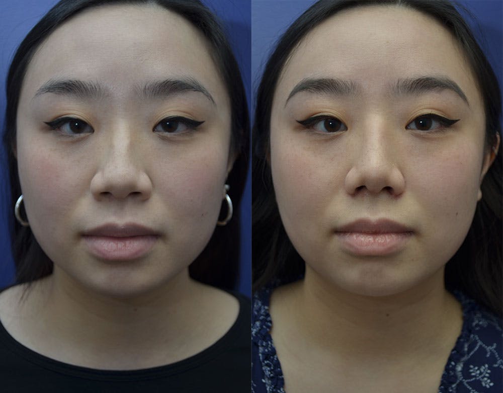 Rhinoplasty (Nose Reshaping) Gallery - Patient 121814151 - Image 3