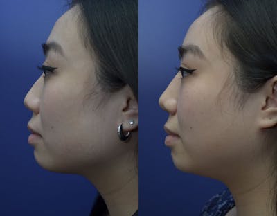 Rhinoplasty (Nose Reshaping) Before & After Gallery - Patient 121814151 - Image 4