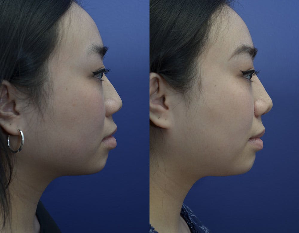 Rhinoplasty (Nose Reshaping) Before & After Gallery - Patient 121814151 - Image 5