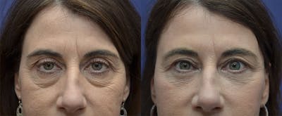 Eyelid Surgery Before & After Gallery - Patient 121814198 - Image 1