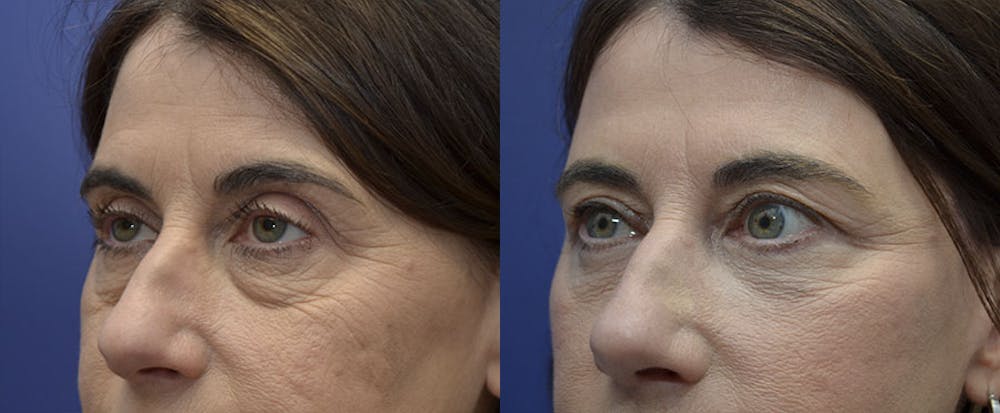 Eyelid Surgery Before & After Gallery - Patient 121814198 - Image 3