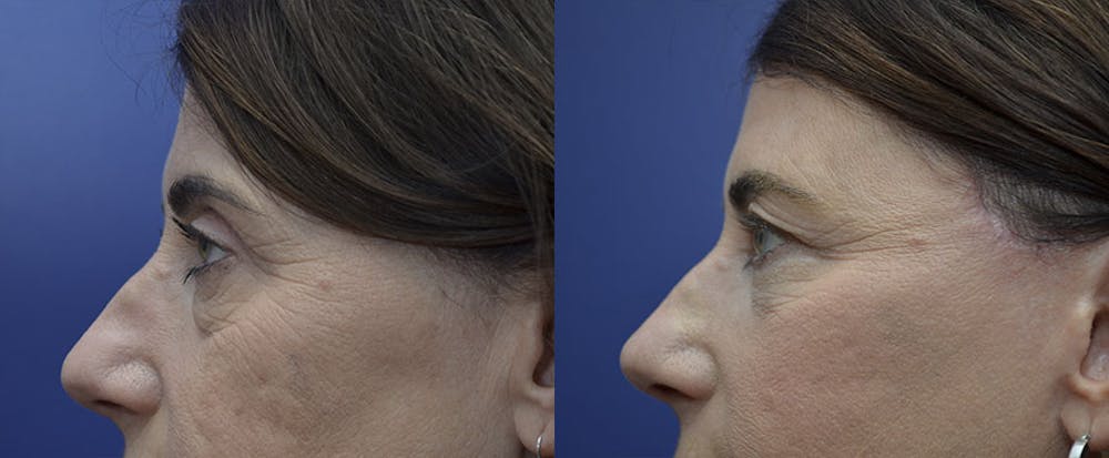 Eyelid Surgery Before & After Gallery - Patient 121814198 - Image 5